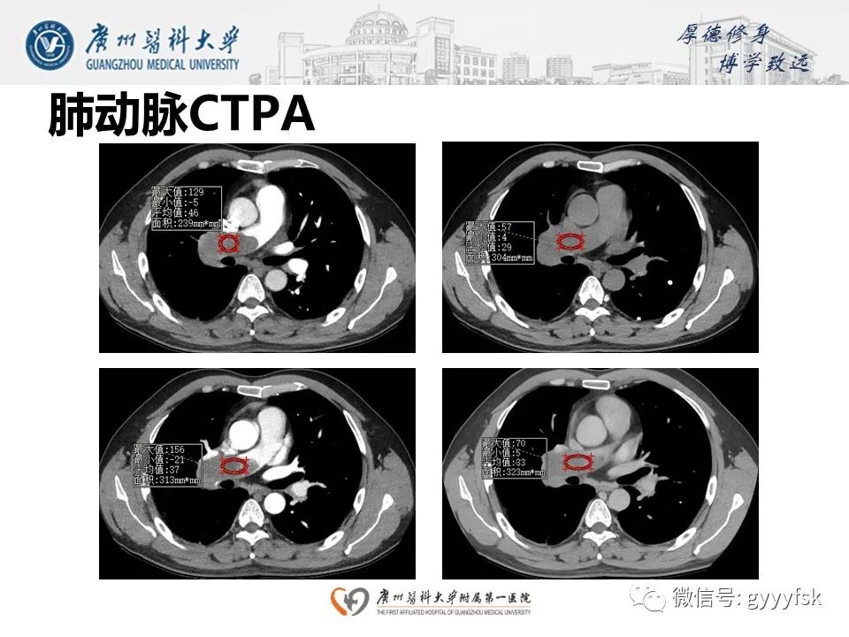 影像PPT - 【病例】肺动脉肉瘤1例CT影像-7