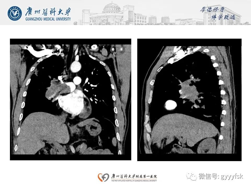 影像PPT - 【病例】肺动脉肉瘤1例CT影像-8