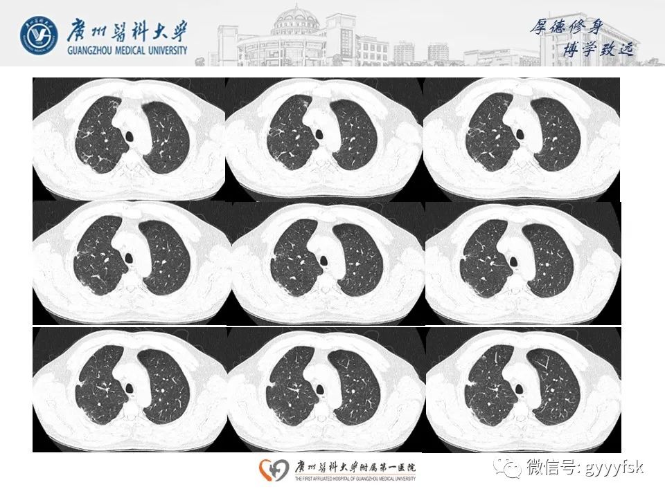 影像PPT - 【病例】肺动脉肉瘤1例CT影像-9