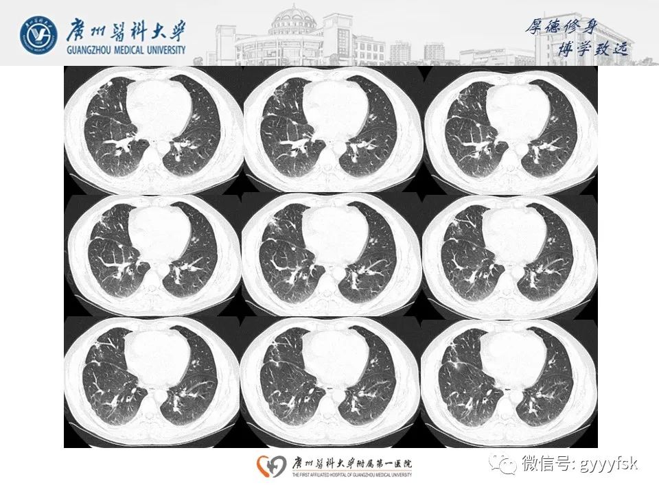 影像PPT - 【病例】肺动脉肉瘤1例CT影像-10