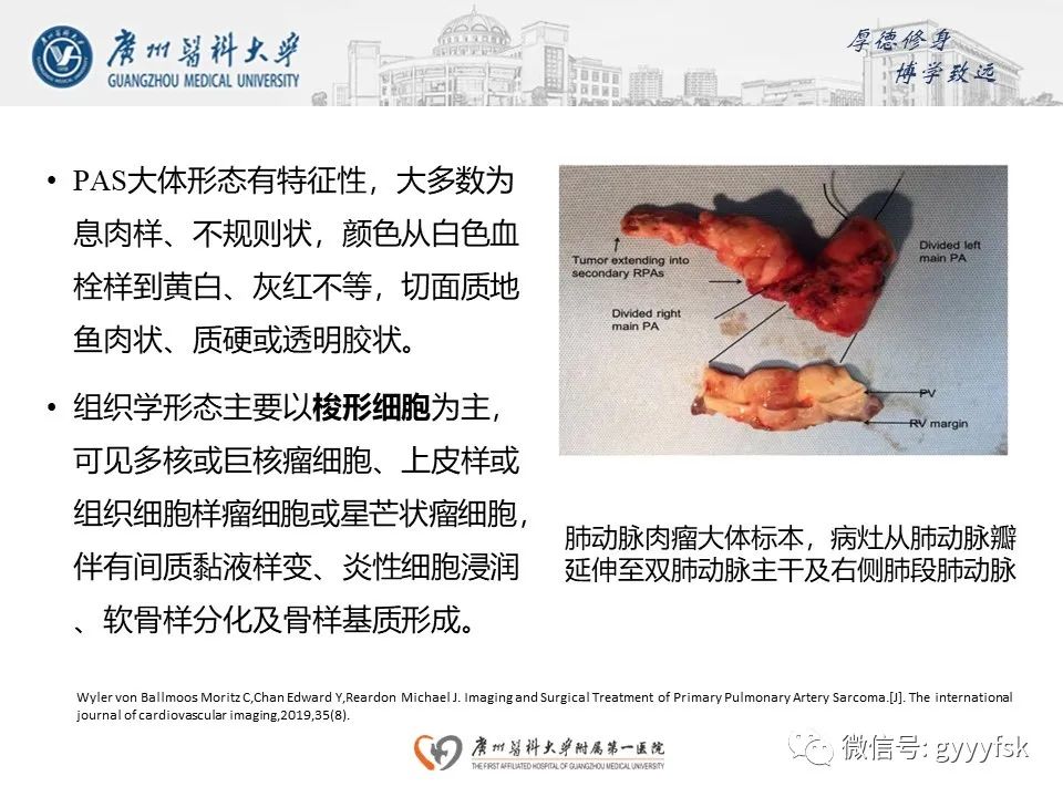影像PPT - 【病例】肺动脉肉瘤1例CT影像-19