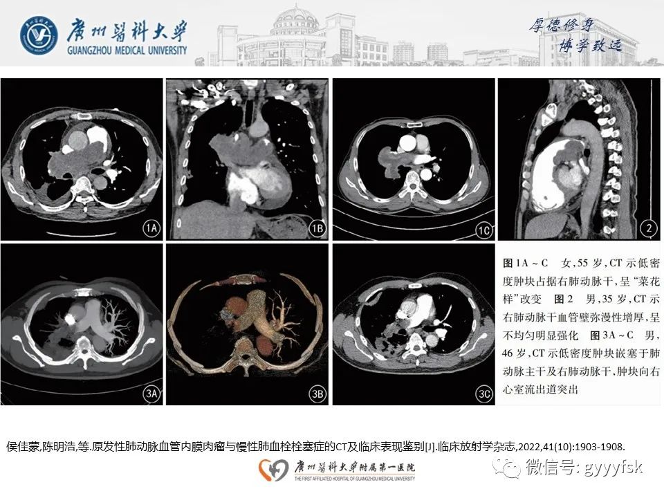 影像PPT - 【病例】肺动脉肉瘤1例CT影像-22