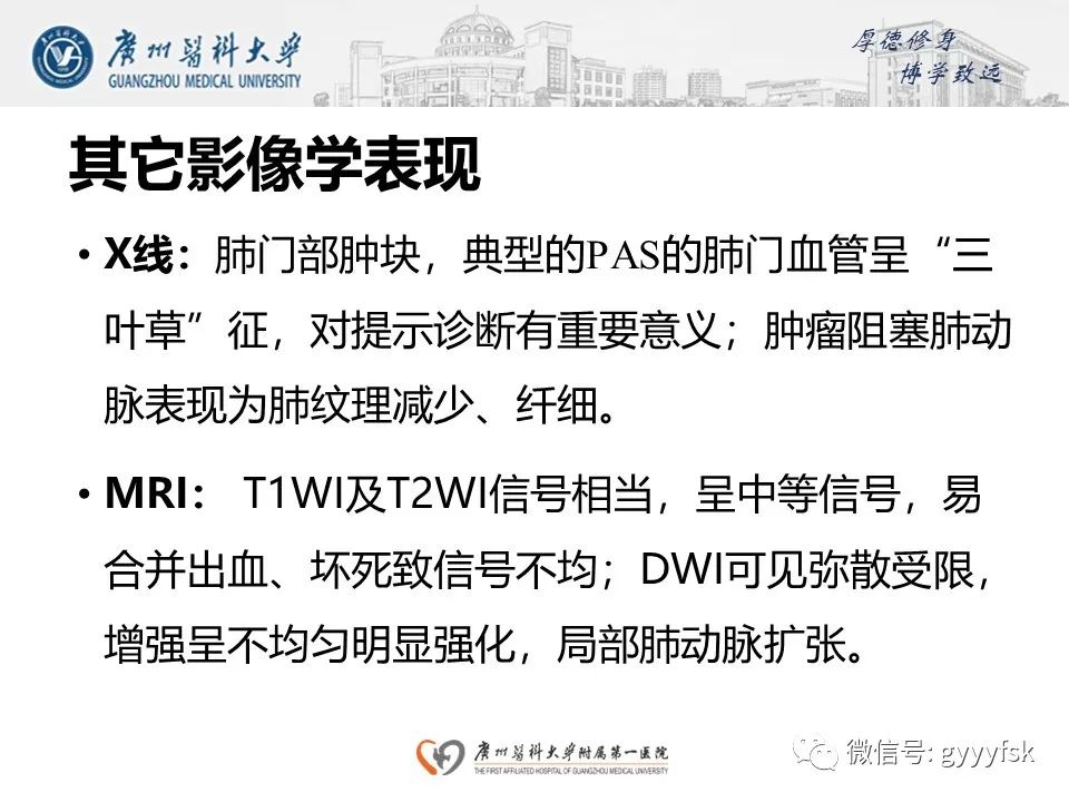 影像PPT - 【病例】肺动脉肉瘤1例CT影像-23