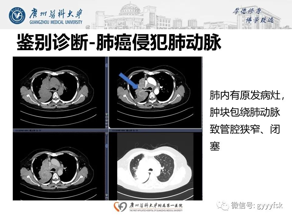 影像PPT - 【病例】肺动脉肉瘤1例CT影像-25