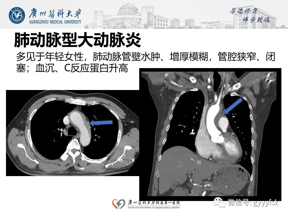 影像PPT - 【病例】肺动脉肉瘤1例CT影像-26