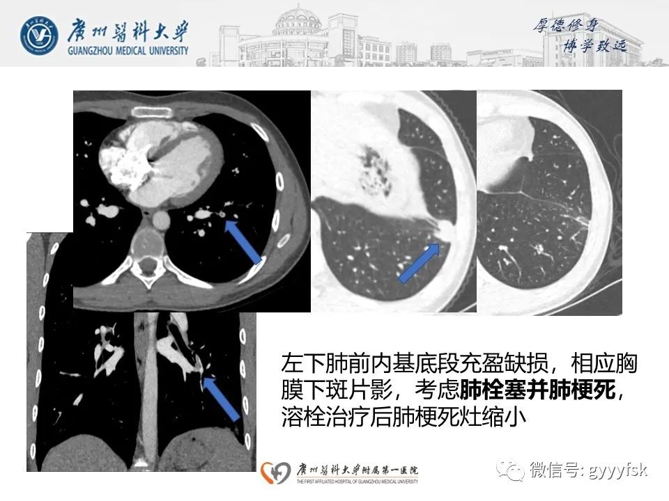 影像PPT - 【病例】肺动脉肉瘤1例CT影像-29
