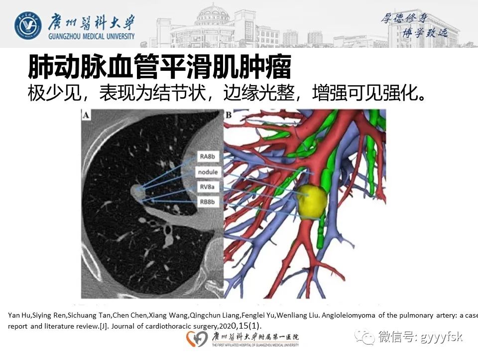 影像PPT - 【病例】肺动脉肉瘤1例CT影像-27