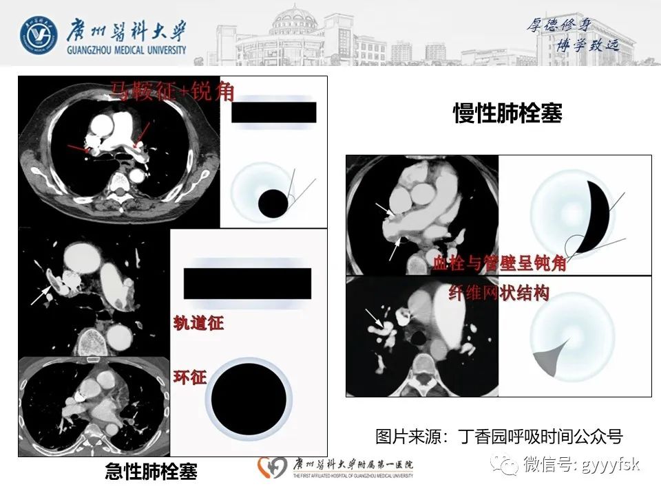 影像PPT - 【病例】肺动脉肉瘤1例CT影像-32