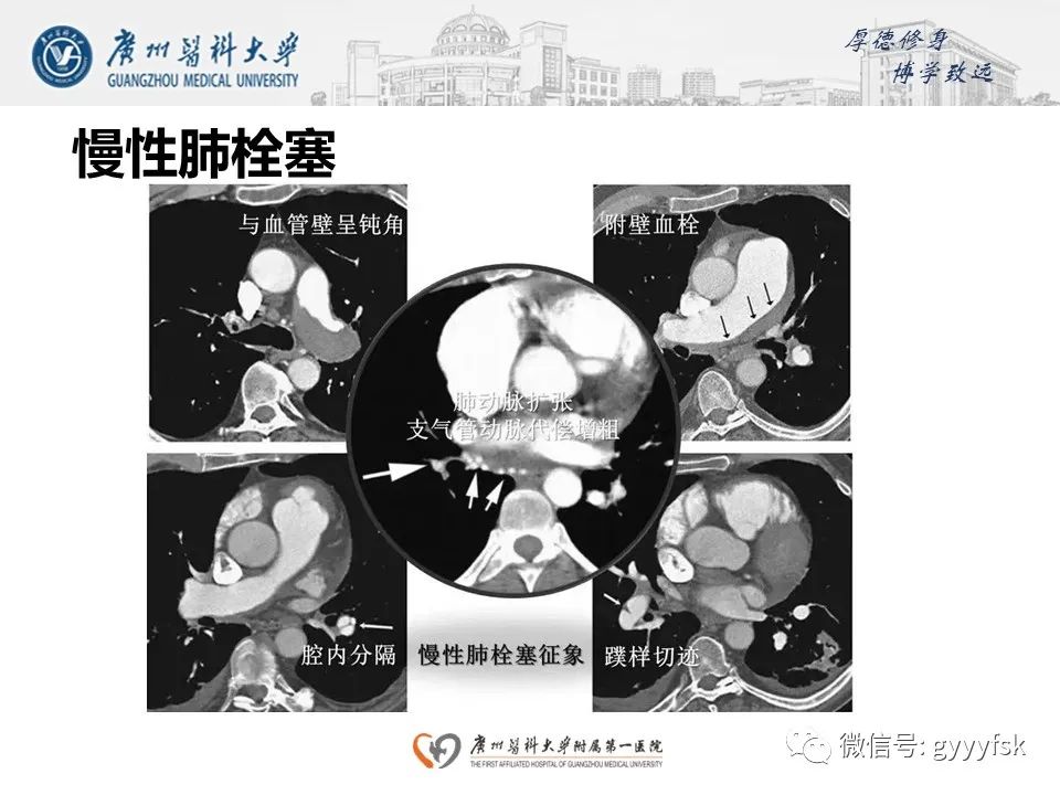 影像PPT - 【病例】肺动脉肉瘤1例CT影像-33