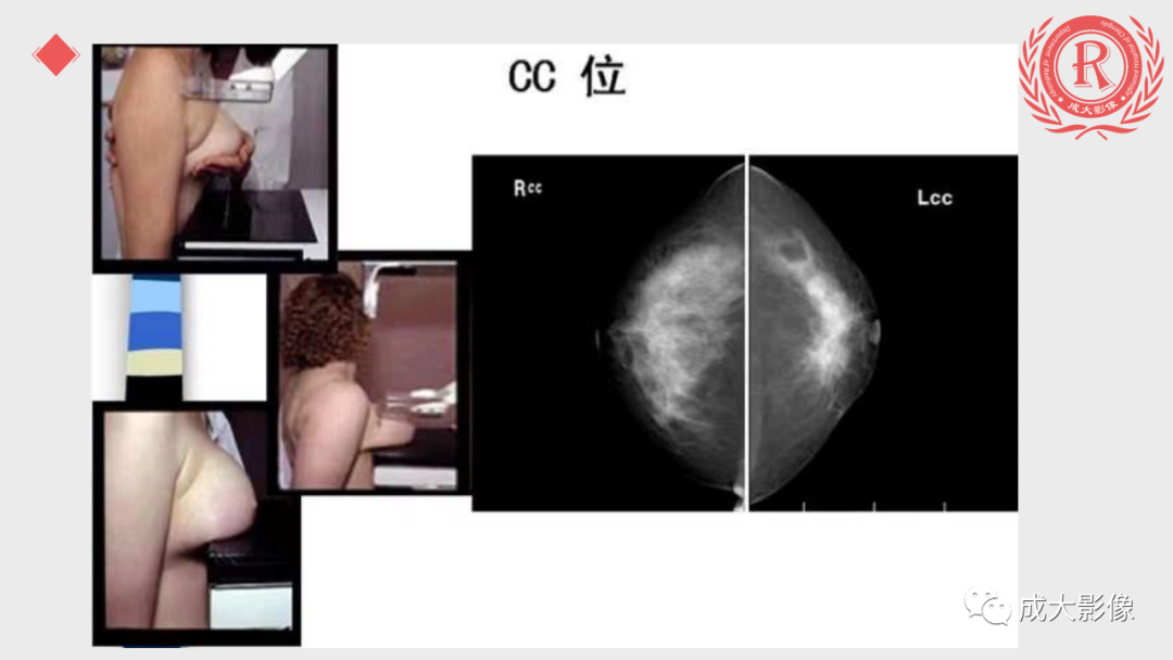 影像PPT - 【PPT】乳腺影像学检查-8