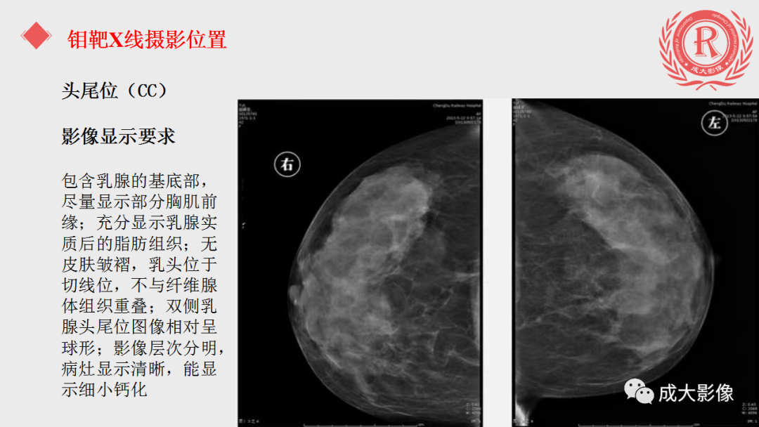 影像PPT - 【PPT】乳腺影像学检查-9