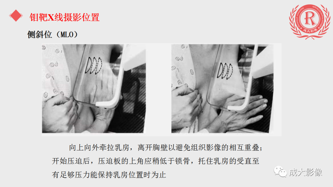 影像PPT - 【PPT】乳腺影像学检查-12