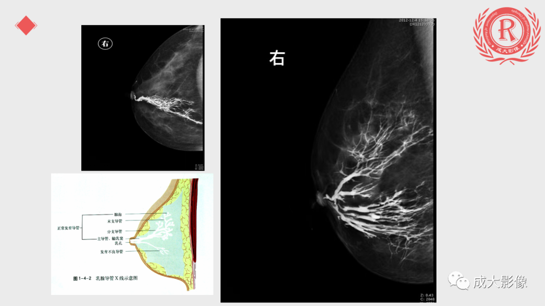 影像PPT - 【PPT】乳腺影像学检查-17