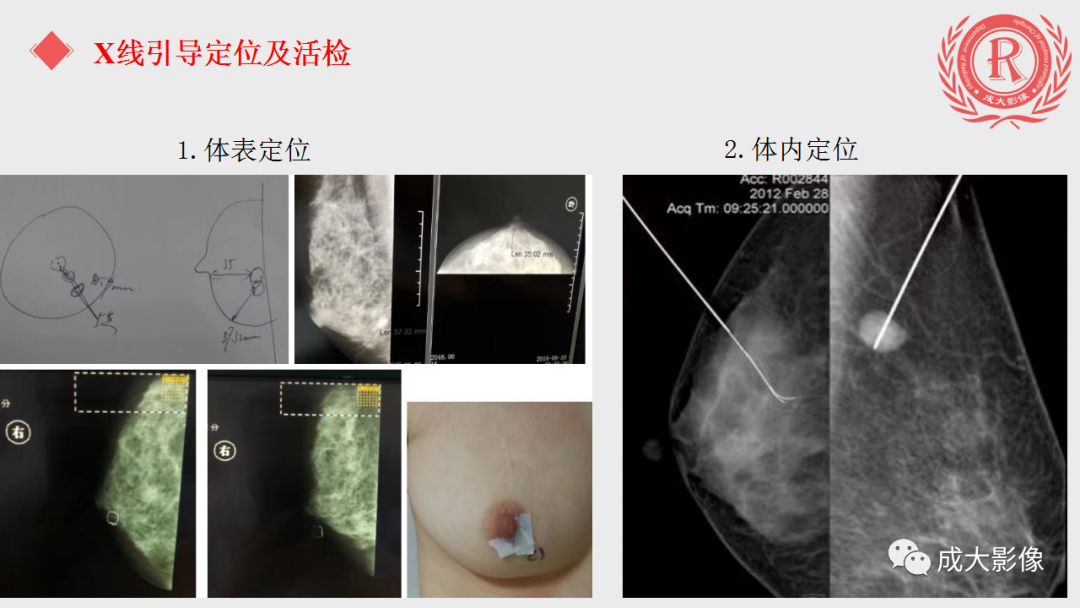 影像PPT - 【PPT】乳腺影像学检查-18