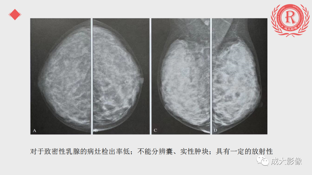 影像PPT - 【PPT】乳腺影像学检查-22