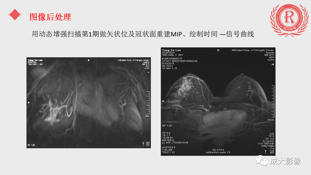 影像PPT - 【PPT】乳腺影像学检查-39