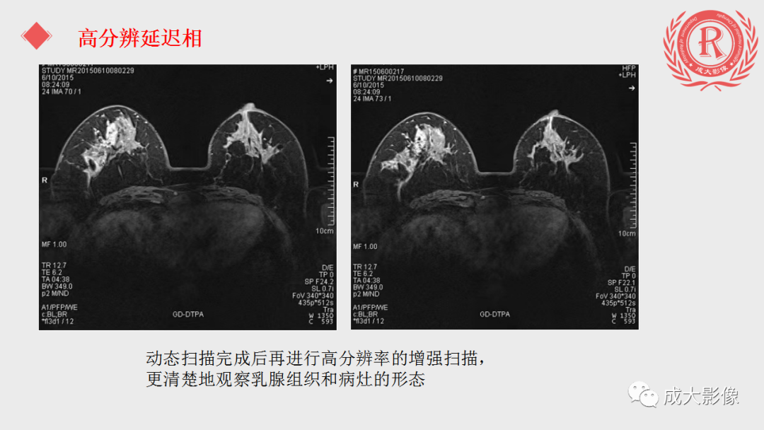 影像PPT - 【PPT】乳腺影像学检查-41