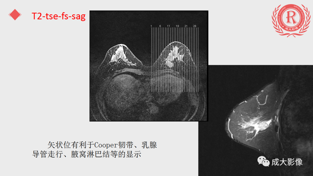 影像PPT - 【PPT】乳腺影像学检查-45
