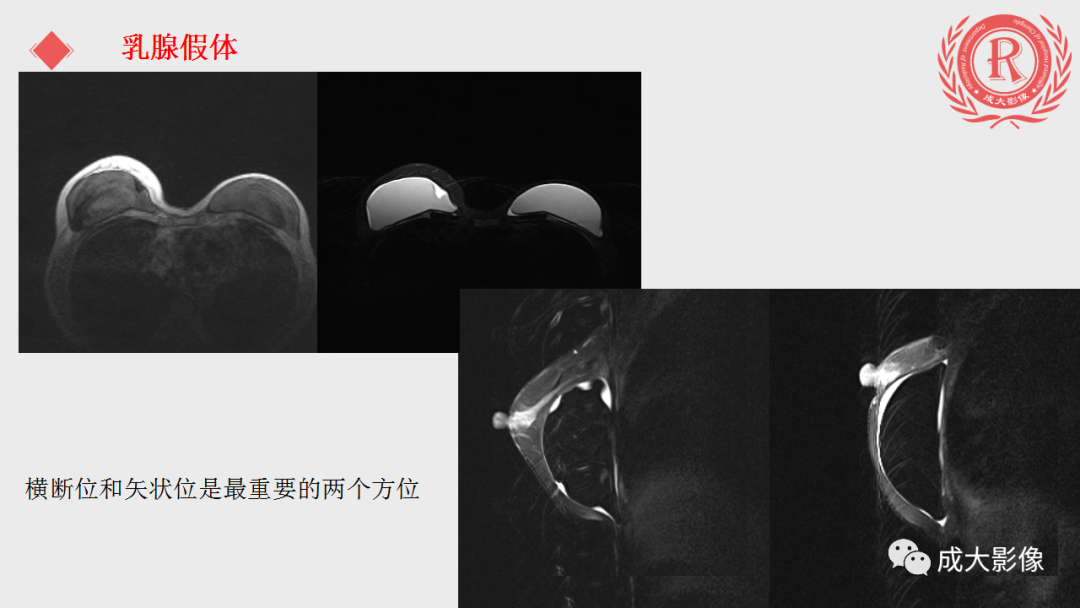 影像PPT - 【PPT】乳腺影像学检查-46
