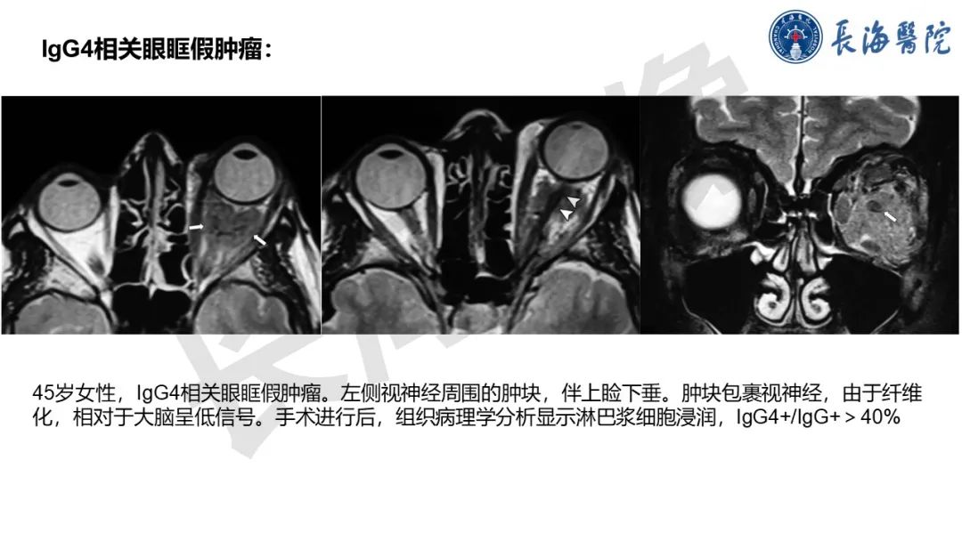 影像PPT - 【PPT】IgG4相关性疾病-20