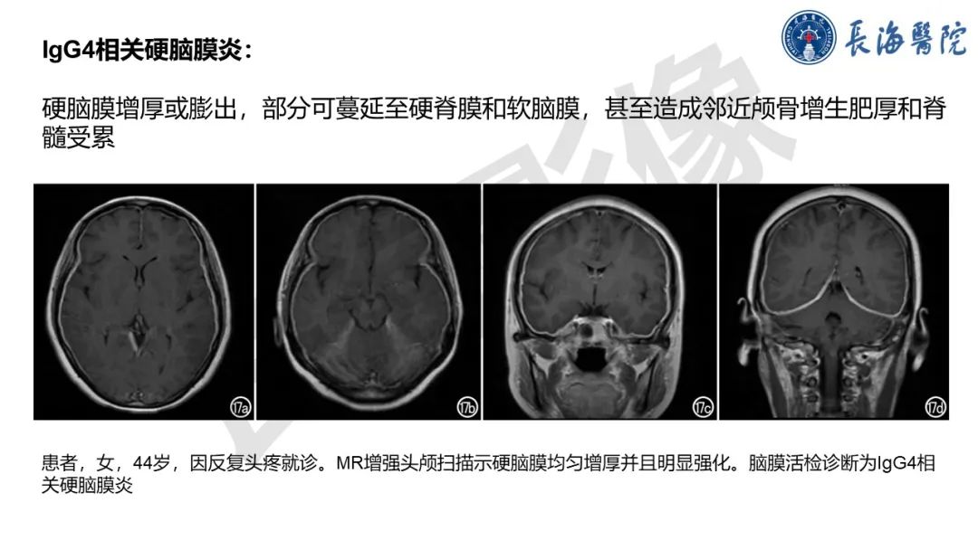 影像PPT - 【PPT】IgG4相关性疾病-21