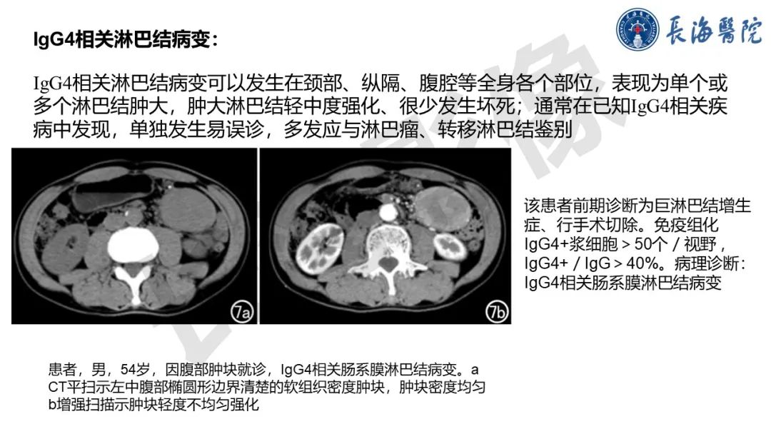影像PPT - 【PPT】IgG4相关性疾病-22