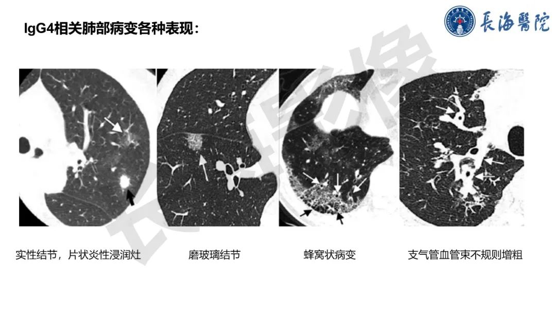 影像PPT - 【PPT】IgG4相关性疾病-26