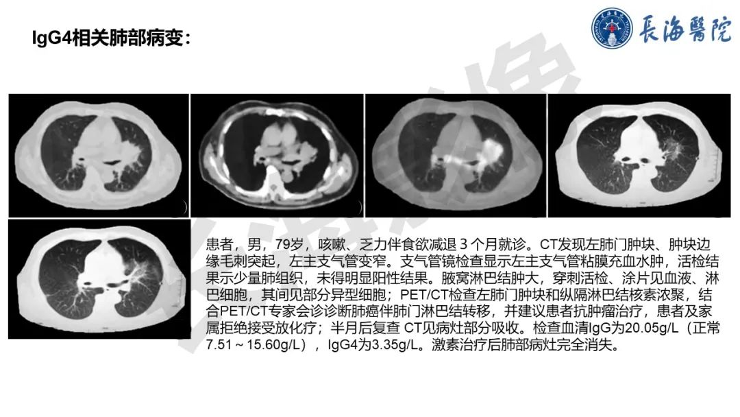 影像PPT - 【PPT】IgG4相关性疾病-28