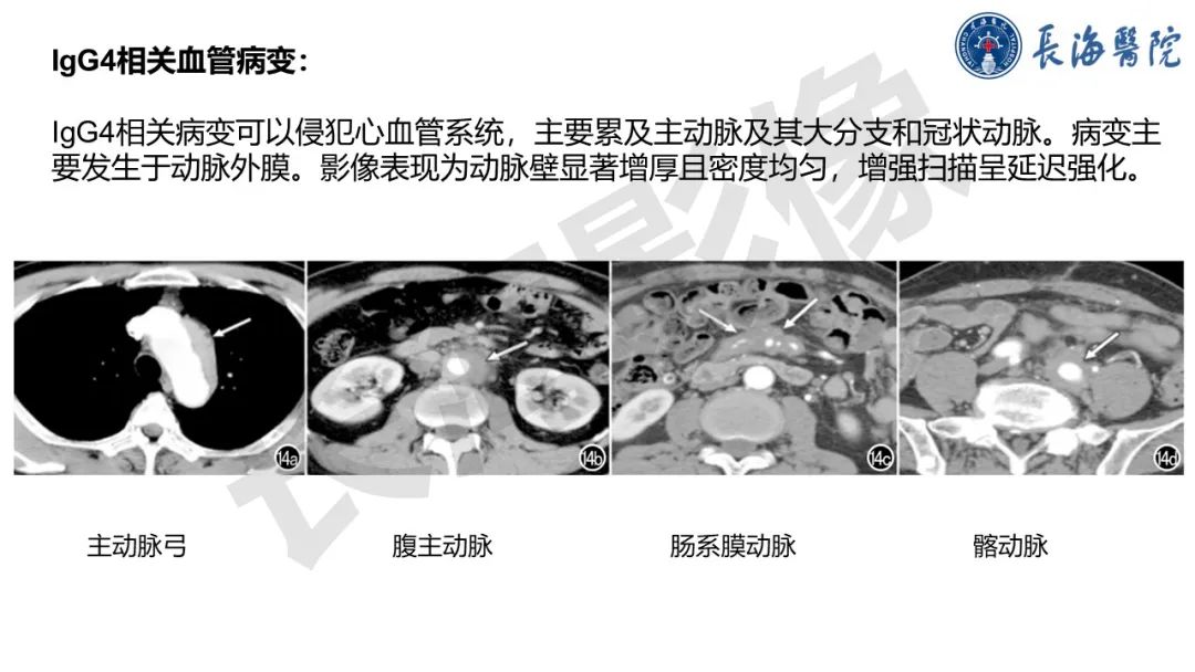 影像PPT - 【PPT】IgG4相关性疾病-30
