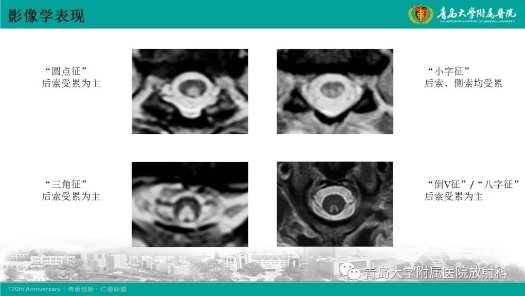 影像PPT - 【病例】脊髓亚急性联合变性1例MR影像-15