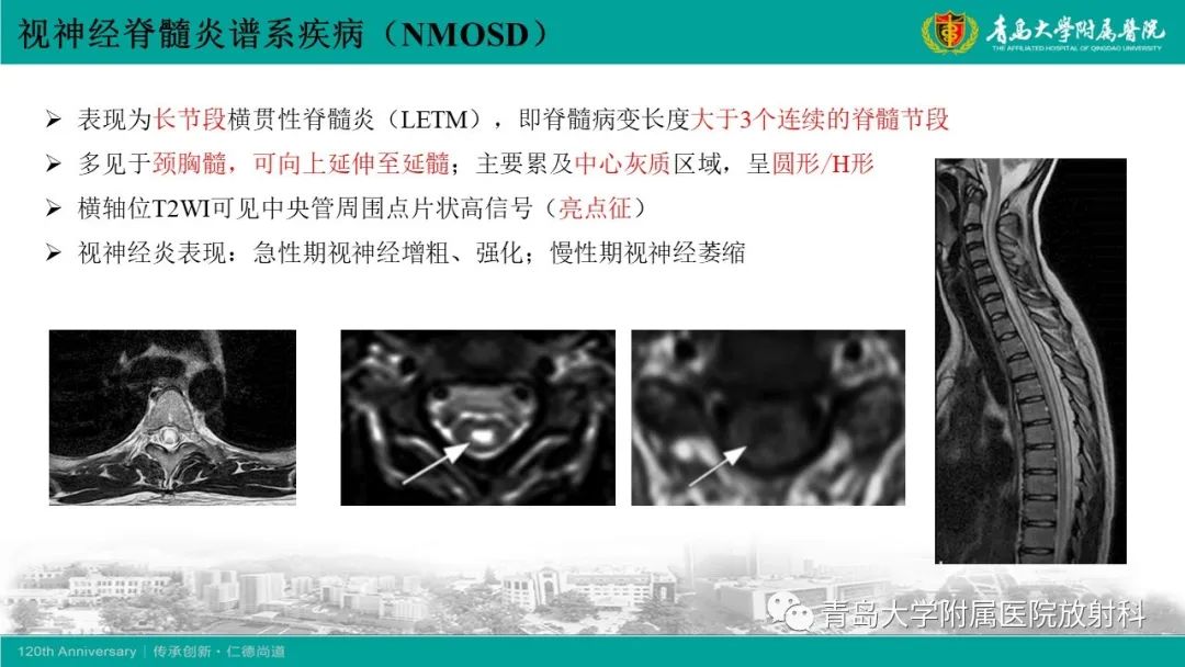 影像PPT - 【病例】脊髓亚急性联合变性1例MR影像-17