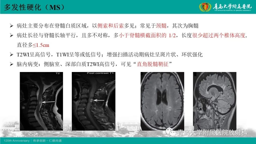 影像PPT - 【病例】脊髓亚急性联合变性1例MR影像-19