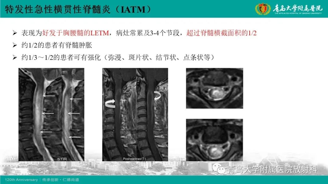 影像PPT - 【病例】脊髓亚急性联合变性1例MR影像-20