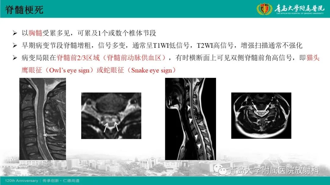 影像PPT - 【病例】脊髓亚急性联合变性1例MR影像-21