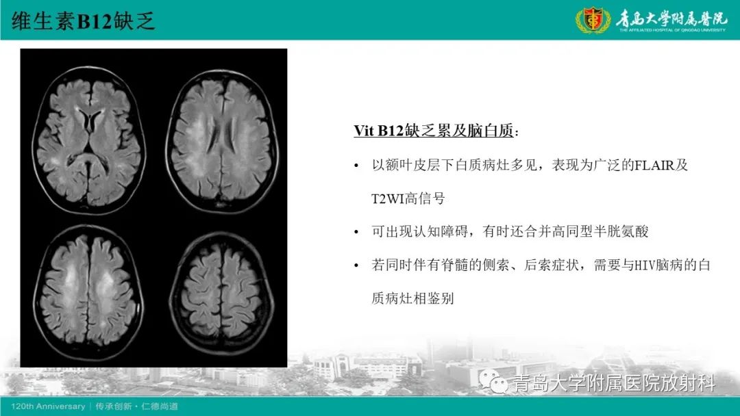 影像PPT - 【病例】脊髓亚急性联合变性1例MR影像-26