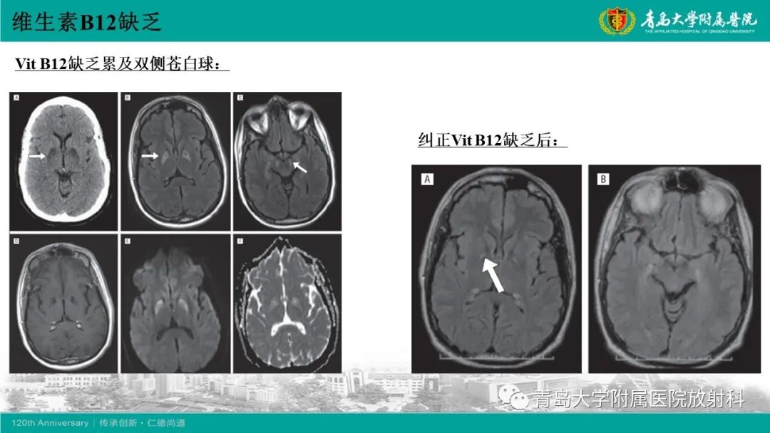 影像PPT - 【病例】脊髓亚急性联合变性1例MR影像-27