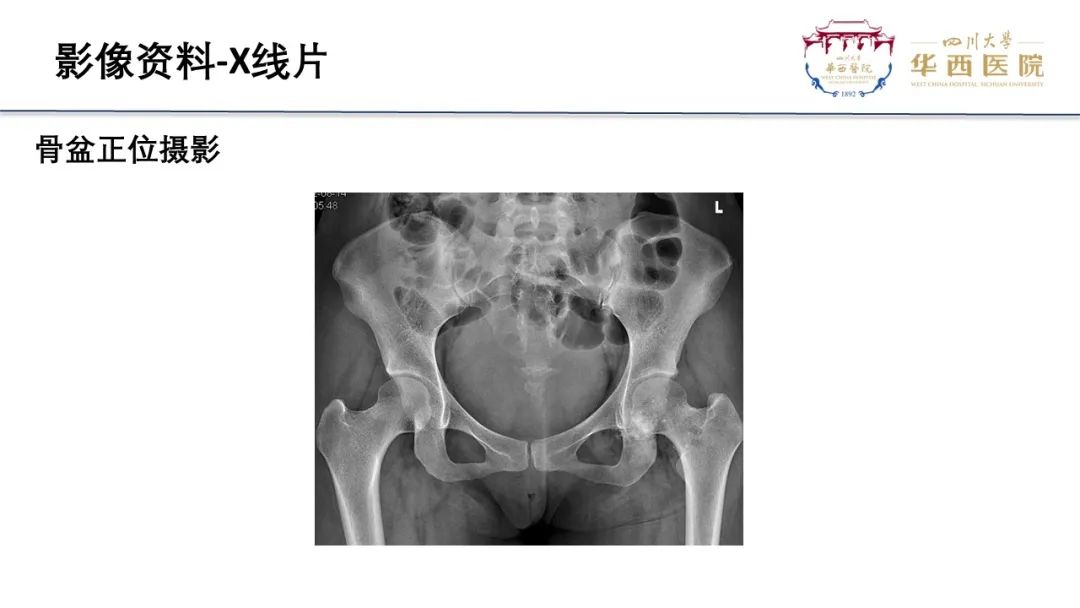 影像PPT - 【病例】骨母细胞瘤样骨肉瘤1例X线CT及MR影像-2
