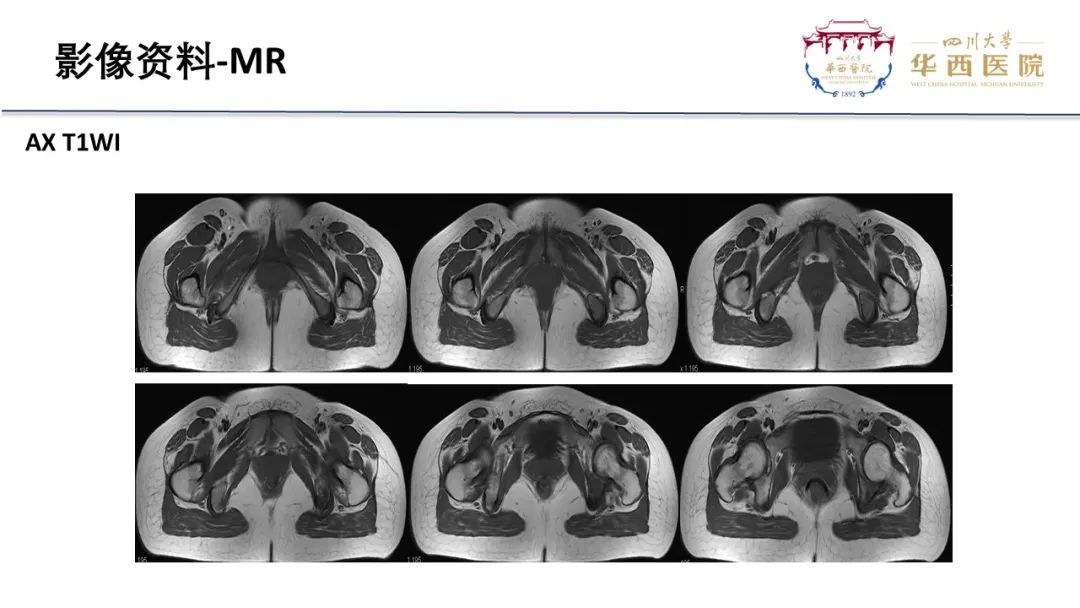 影像PPT - 【病例】骨母细胞瘤样骨肉瘤1例X线CT及MR影像-6