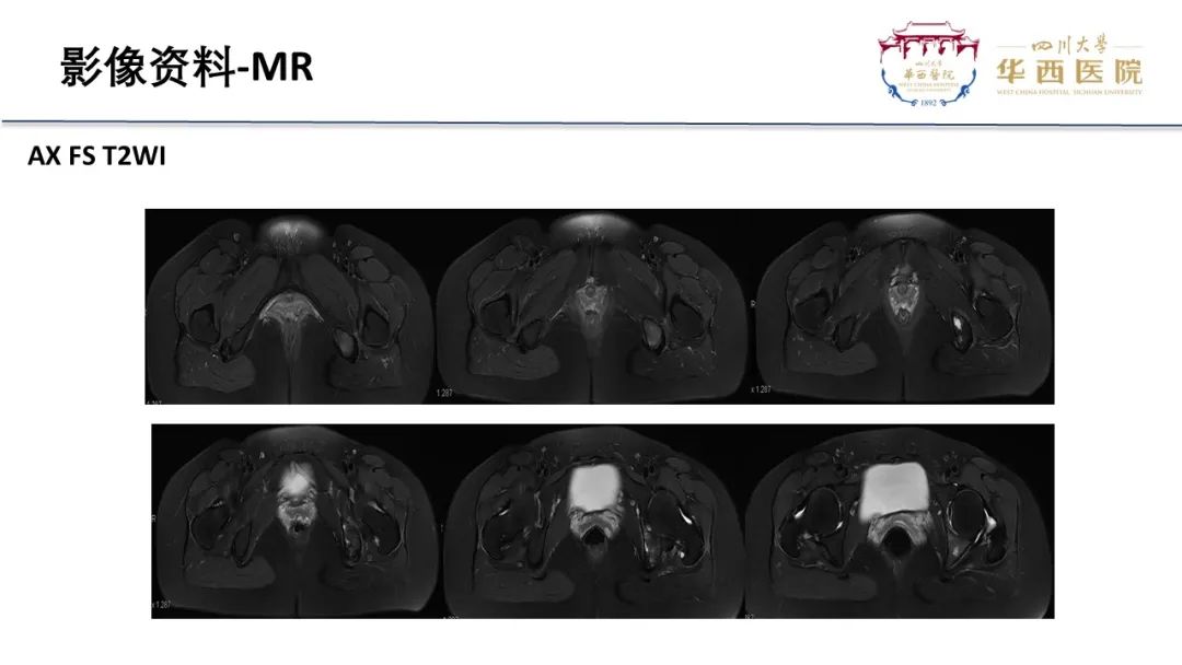 影像PPT - 【病例】骨母细胞瘤样骨肉瘤1例X线CT及MR影像-7