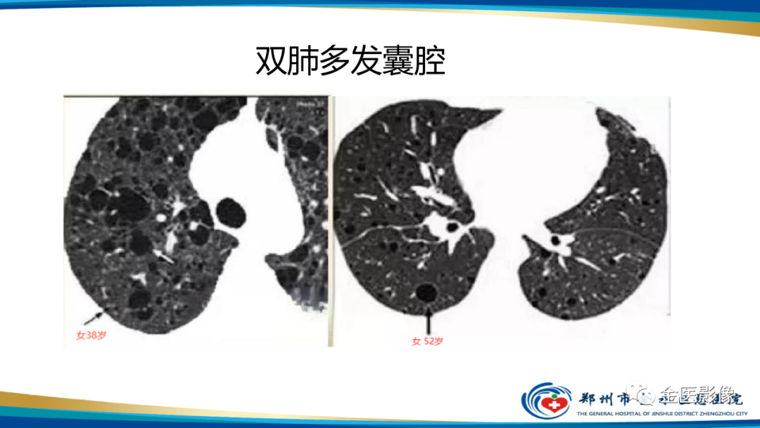 影像PPT - 【PPT】肺淋巴管肌瘤病的CT表现及鉴别-16