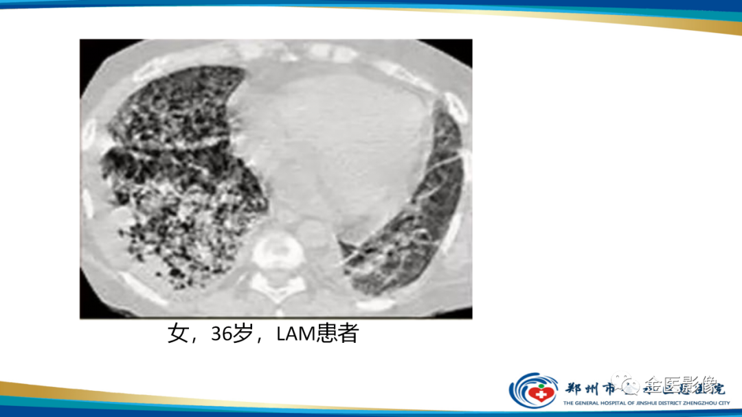 影像PPT - 【PPT】肺淋巴管肌瘤病的CT表现及鉴别-19
