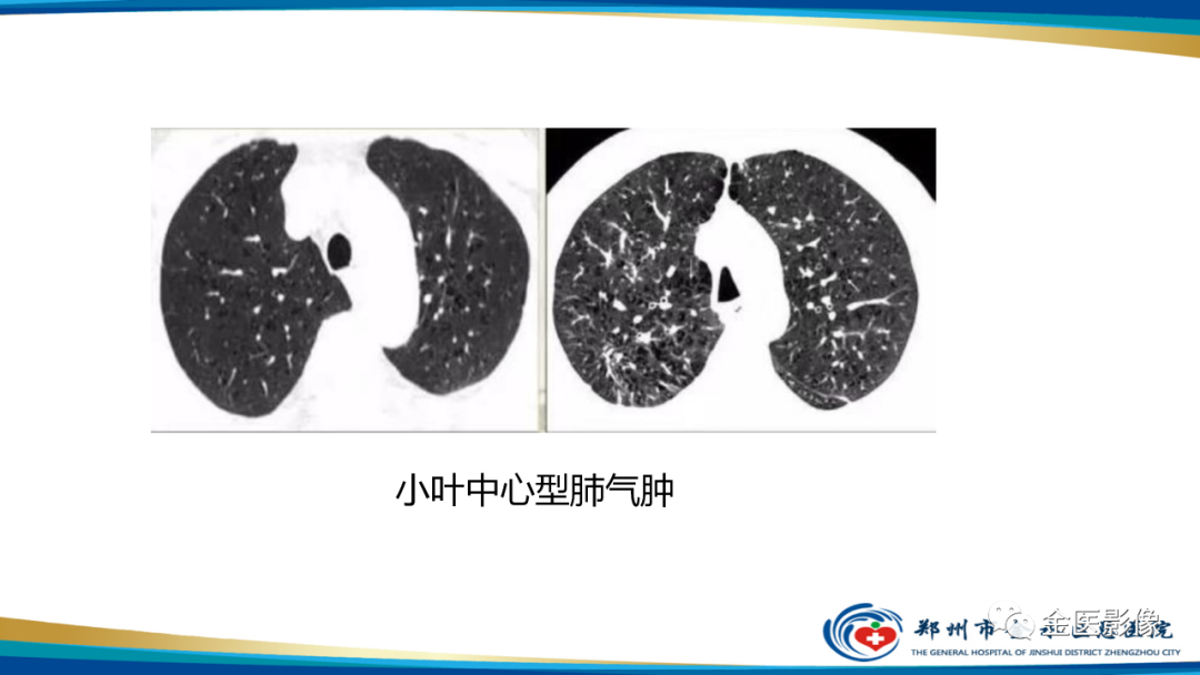 影像PPT - 【PPT】肺淋巴管肌瘤病的CT表现及鉴别-24