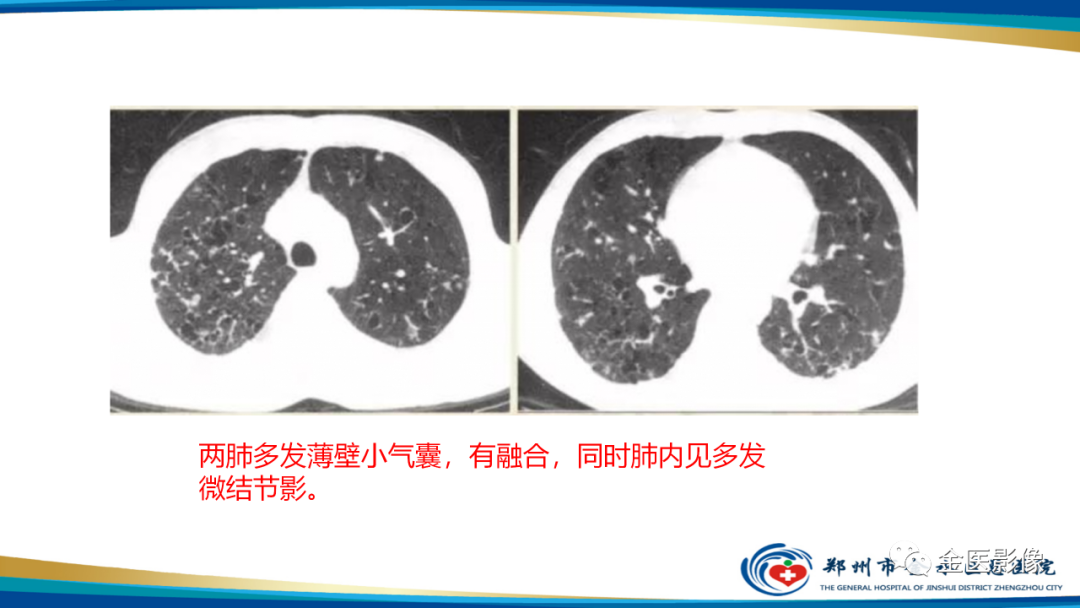 影像PPT - 【PPT】肺淋巴管肌瘤病的CT表现及鉴别-26
