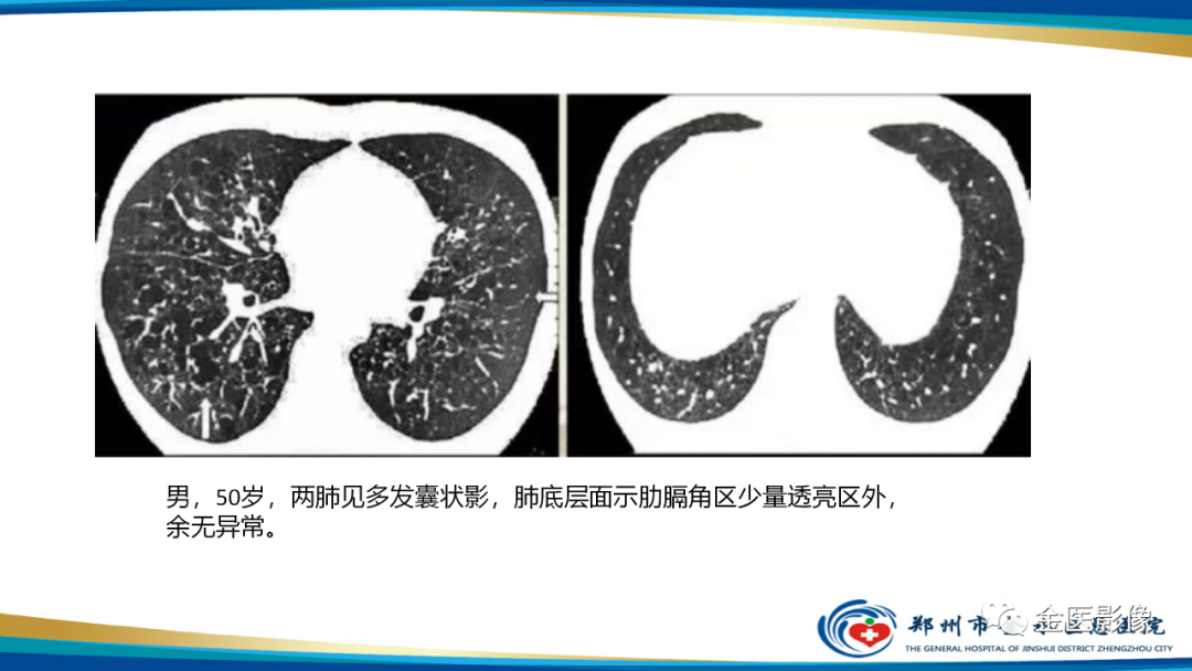 影像PPT - 【PPT】肺淋巴管肌瘤病的CT表现及鉴别-27