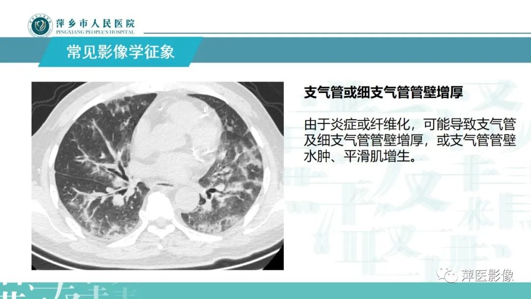 影像PPT - 【PPT】病毒性肺炎解剖、病理和影像诊断-8