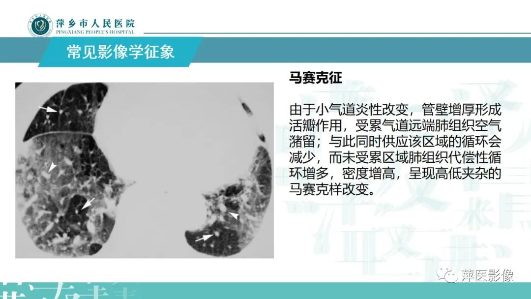 影像PPT - 【PPT】病毒性肺炎解剖、病理和影像诊断-9