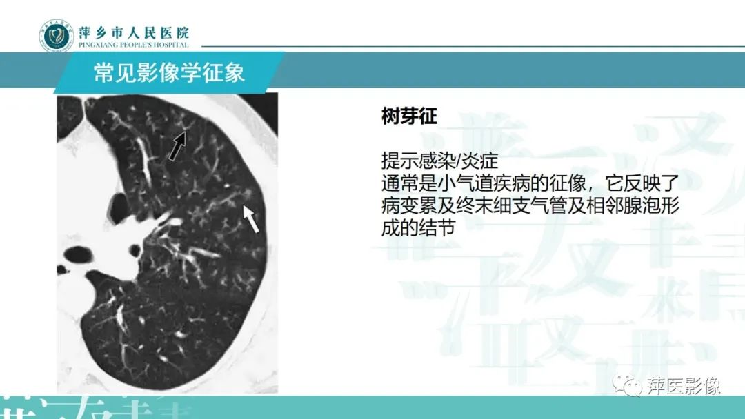 影像PPT - 【PPT】病毒性肺炎解剖、病理和影像诊断-10