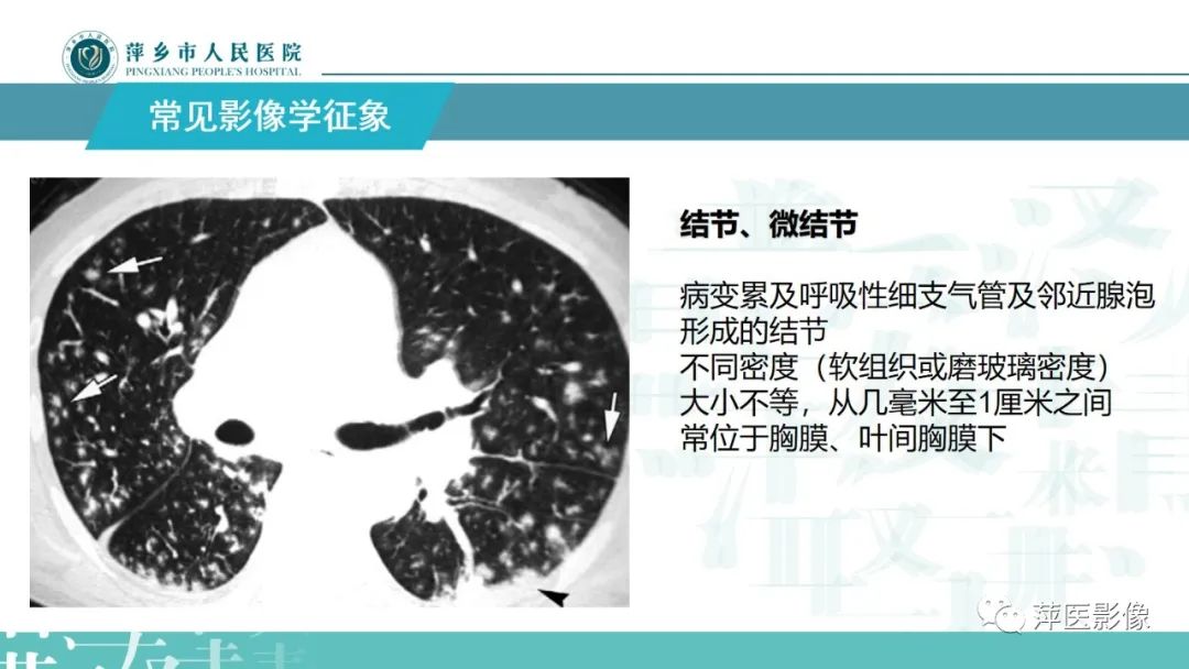 影像PPT - 【PPT】病毒性肺炎解剖、病理和影像诊断-11