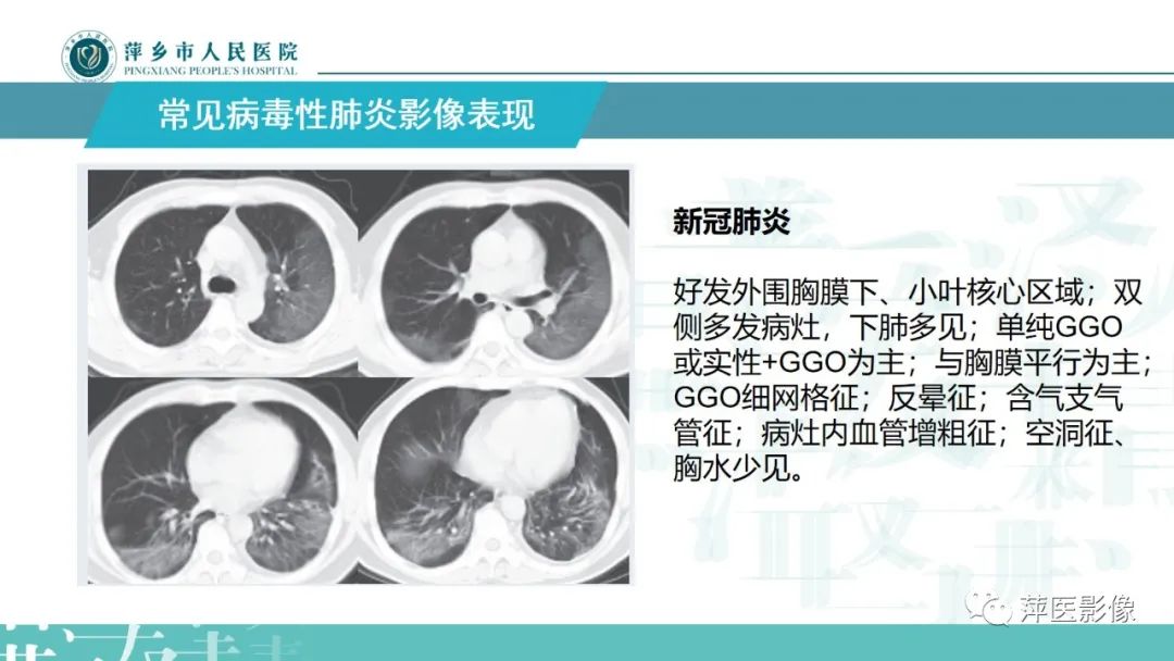 影像PPT - 【PPT】病毒性肺炎解剖、病理和影像诊断-13