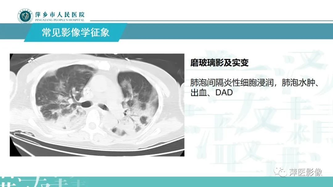 影像PPT - 【PPT】病毒性肺炎解剖、病理和影像诊断-12